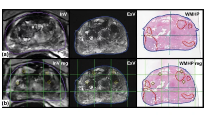 A system using patient-specific 3D-printed molds to spatially align in vivo MRI with ex vivo MRI and whole-mount histopathology for prostate cancer research